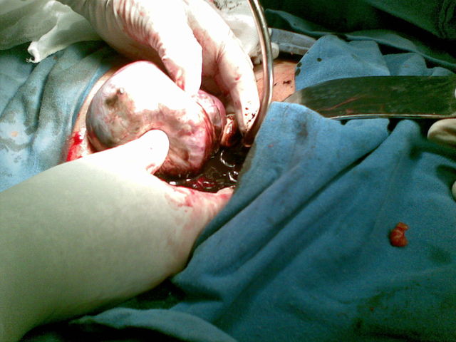 Extrayendo el tumor quístico.
