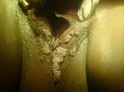 Condilomatosis Vulvoperineal