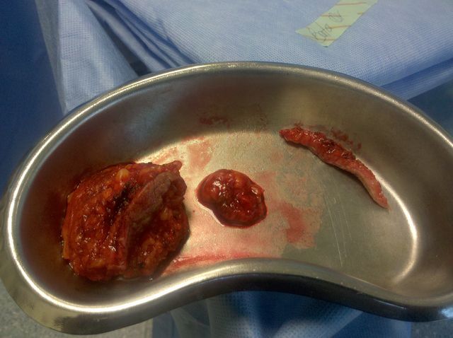 Tejido Glandular Resecado