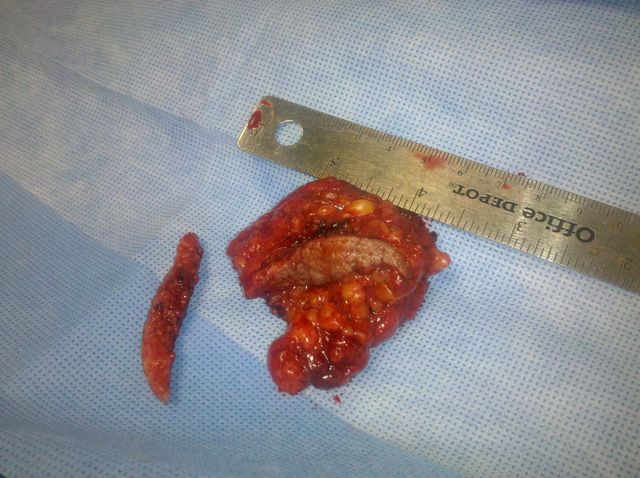 Tejido Glandular Resecado