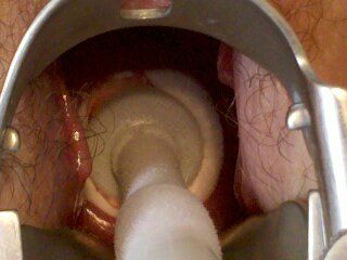 Aplicando el Cryocauterio