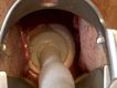 Aplicando el Cryocauterio