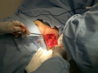 Abriendo la axila para extraer el tejido redundante.