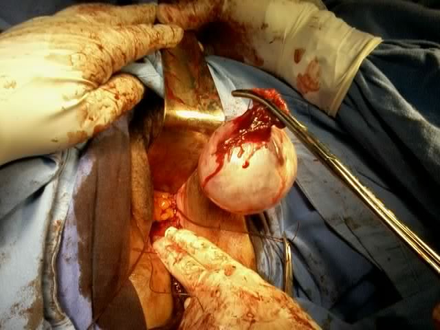 Sí es posible extraerlo por vía vaginal.