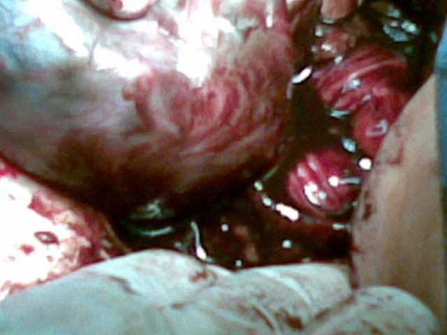 Quiste Endometriósico de Ovario Izquierdo.