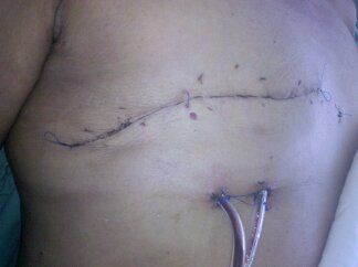 Posterior a una Mastectomía Derecha